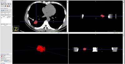 Correlation analysis between unenhanced and enhanced CT radiomic features of lung cancers presenting as solid nodules and their efficacy for predicting hilar and mediastinal lymph node metastases